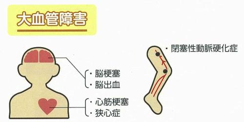 大血管障害の図